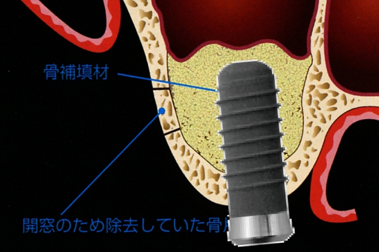 サイナスリフト4.jpg