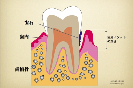 歯周病01.003.jpg