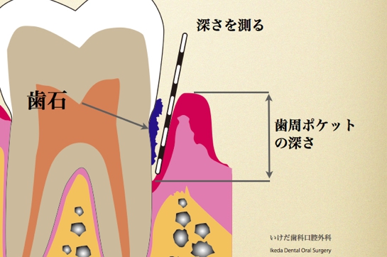 歯周病04.002.jpg